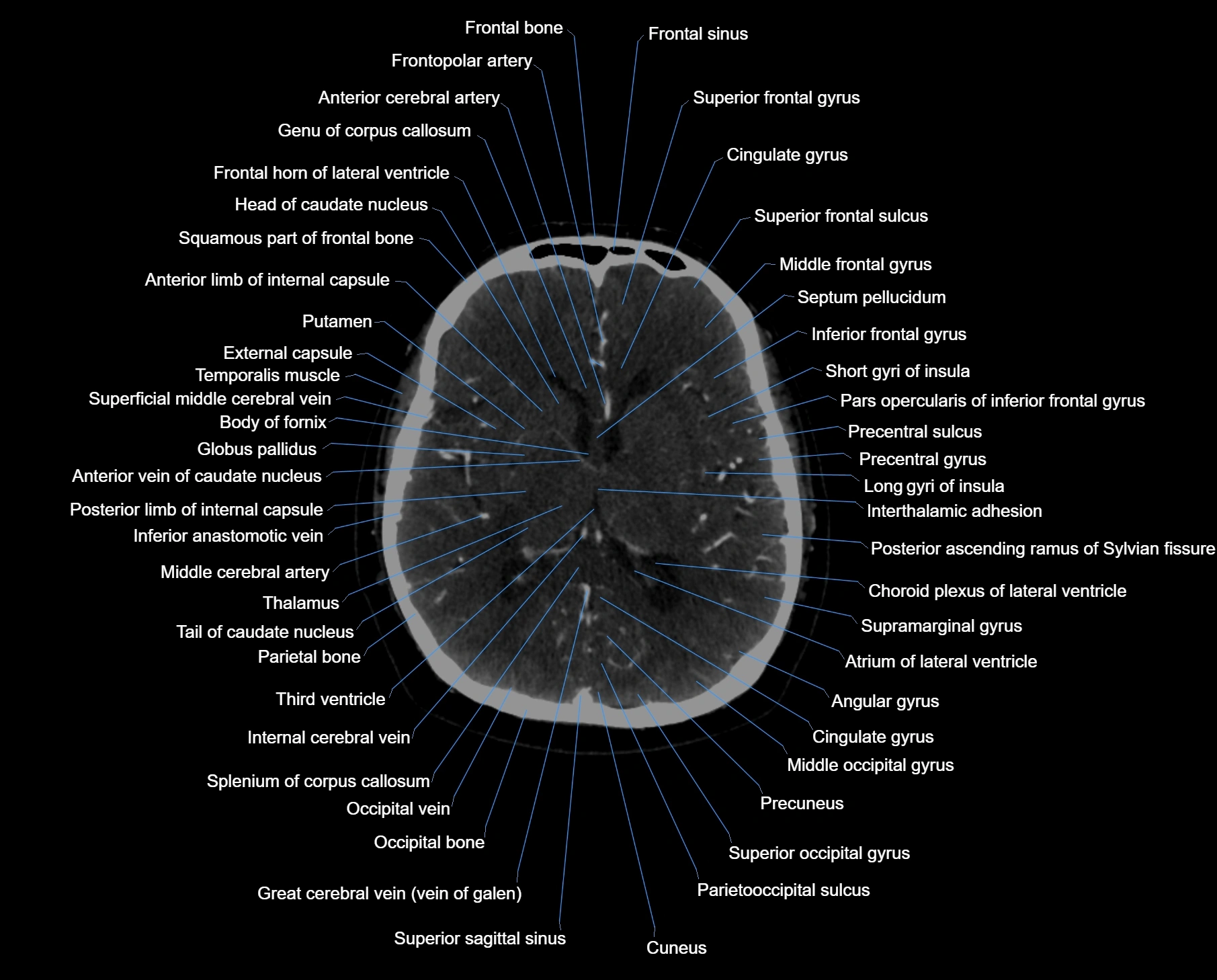 CT scan brain axial labelled cross sectional anatomy image-img-000037.webp